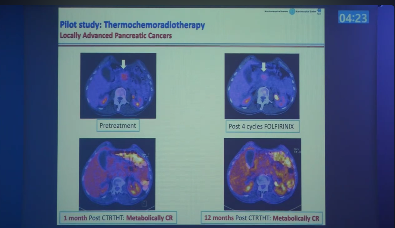 PET CT Cazul 2