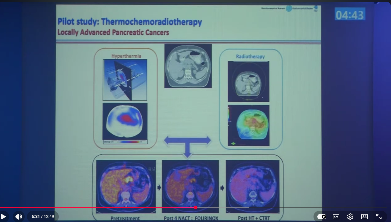PET CT Cazul 1